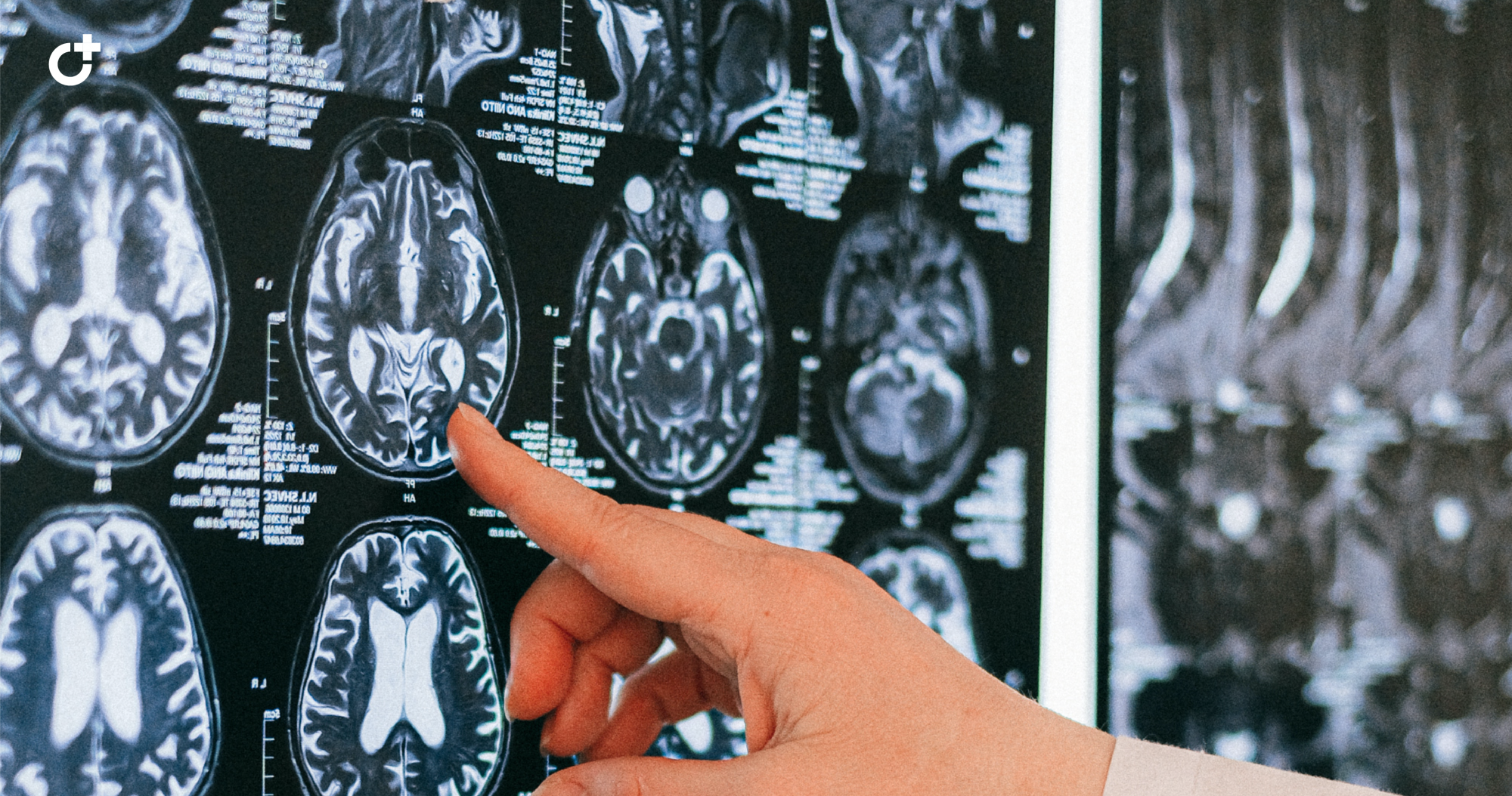 Клинико-радиологический разбор пациента с оптиконевромиелитом и меланомой кожи. Случайное совпадение или коморбидность процессов?