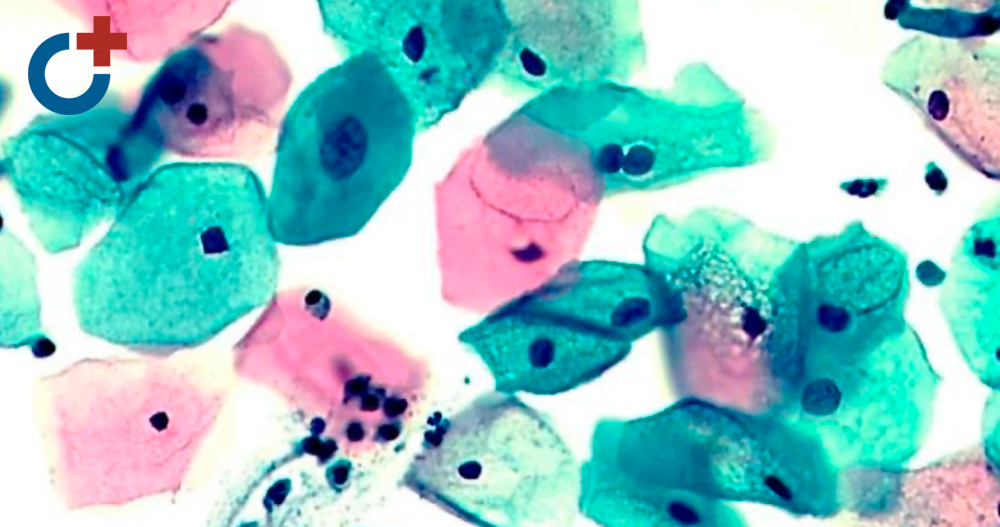 Патология шейки матки. Диалог гинеколога и цитолога