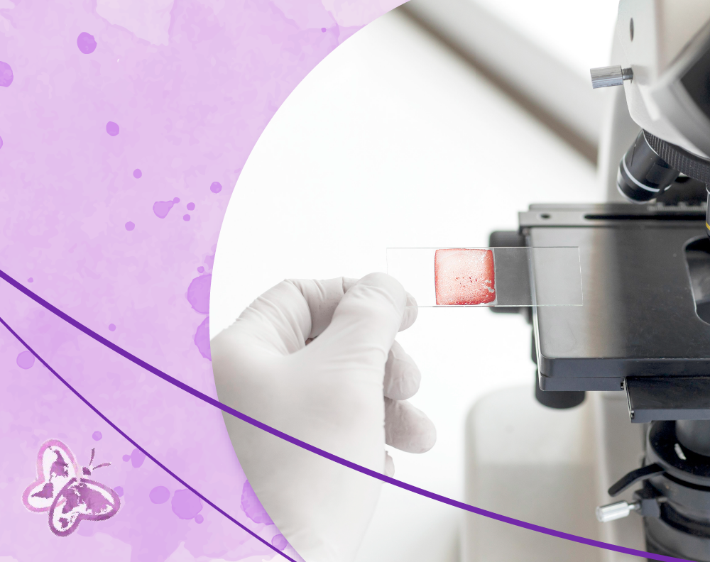 Диагностика поражения почек при СКВ: современные подходы