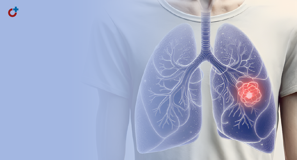 Комбинированное лечение рака легкого: дуэт химиотерапевта и хирурга или сольная партия каждого?