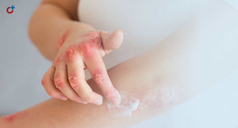 Атопический дерматит и себорейный дерматит. Общее и различия