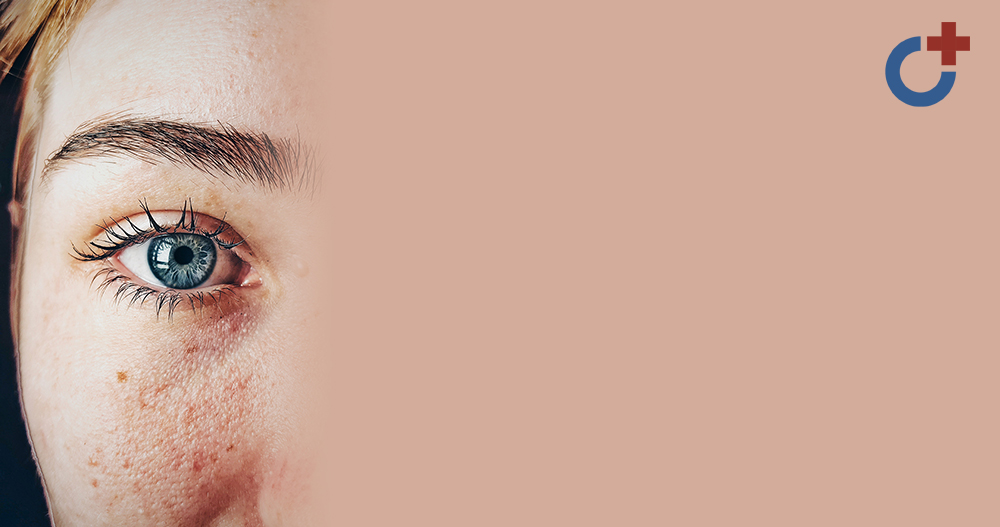 Розацеа: клинические рекомендации с точки зрения международных экспертов