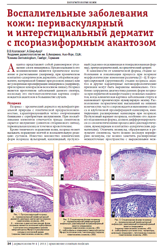 Воспалительные заболевания кожи: периваскулярный  и интерстициальный дерматит  c псориазиформным акантозом