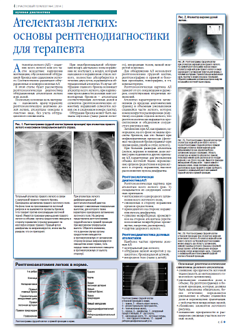 Ателектазы легких:  основы рентгенодиагностики для терапевта