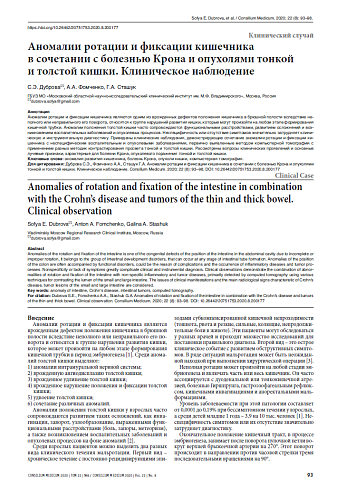 Аномалии ротации и фиксации кишечника  в сочетании с болезнью Крона и опухолями тонкой  и толстой кишки. Клиническое наблюдение
