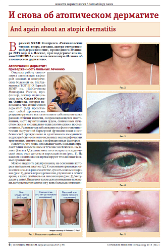 И снова об атопическом дерматите