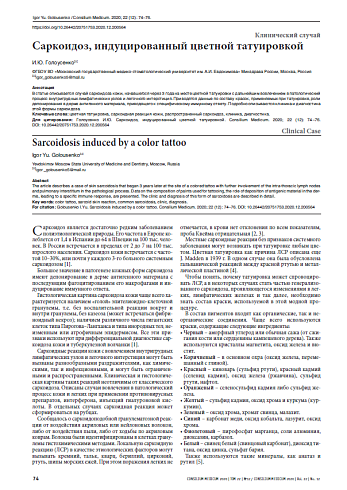 Саркоидоз, индуцированный цветной татуировкой