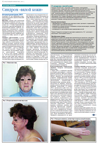   Синдром «вялой кожи»
