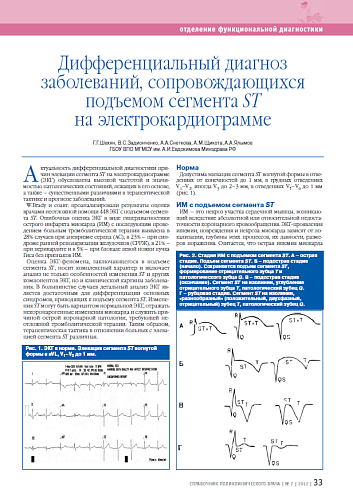 Дифференциальный диагноз заболеваний, сопровождающихся подъемом сегмента ST на электрокардиограмме