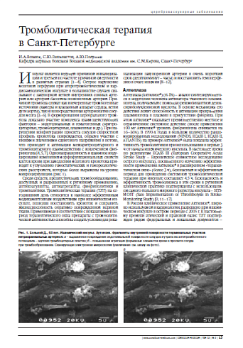 Тромболитическая терапия в Санкт-Петербурге