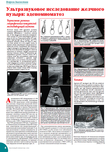 Ультразвуковое исследование желчного пузыря: аденомиоматоз