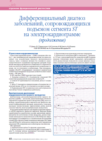 Дифференциальный диагноз заболеваний, сопровождающихся подъемом сегмента ST на электрокардиограмме (продолжение)