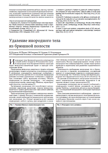 Удаление инородного тела  из брюшной полости