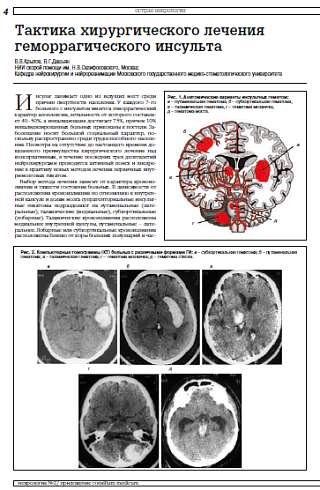 Тактика хирургического лечения геморрагического инсульта
