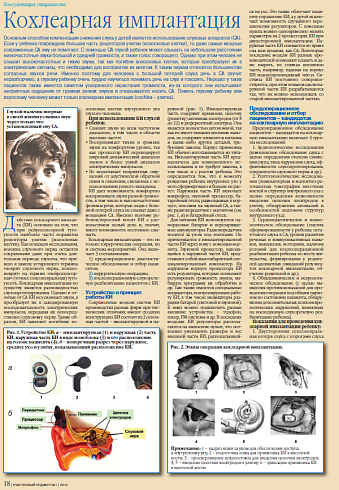 Кохлеарная имплантация