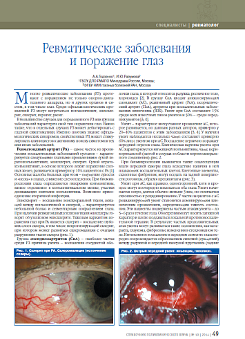 Ревматические заболевания и поражение глаз