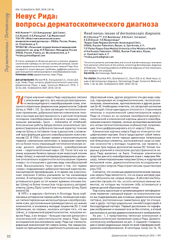 Невус Рида:  вопросы дерматоскопического диагноза