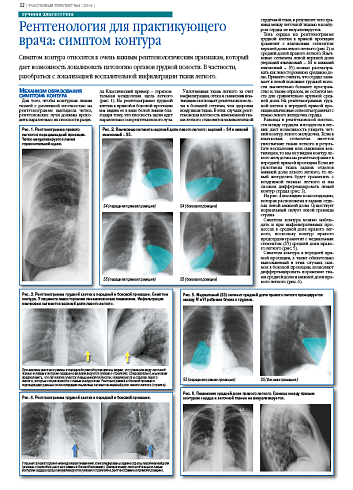Рентгенология для практикующего врача: симптом контура