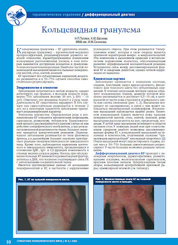 Кольцевидная гранулема