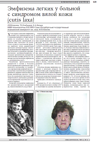 Эмфизема легких у больной с синдромом вялой кожи (cutis laxa)