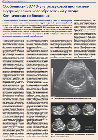 Особенности 3D/4D-ультразвуковой диагностики внутричерепных новообразований у плода.  Клинические наблюдения