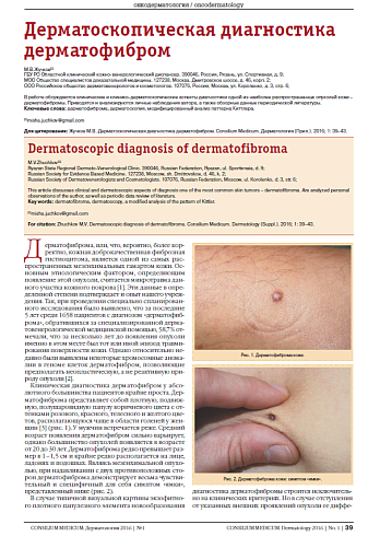 Дерматоскопическая диагностика дерматофибром
