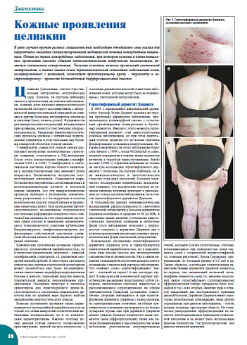 Кожные проявления целиакии