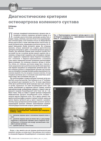 Диагностические критерии остеоартроза коленного сустава