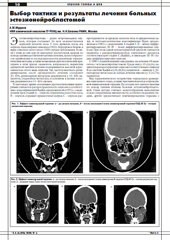 Выбор тактики и результаты лечения больных эстезионейробластомой