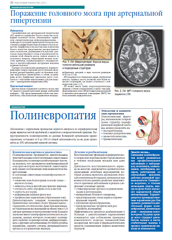 Полиневропатия