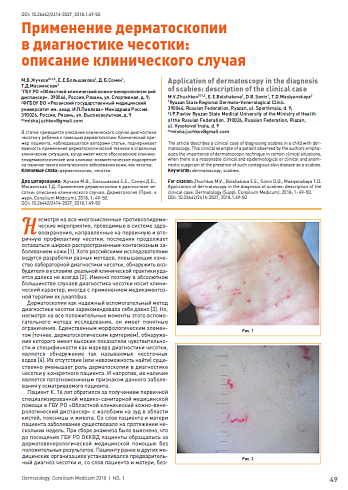 Применение дерматоскопии в диагностике чесотки:  описание клинического случая