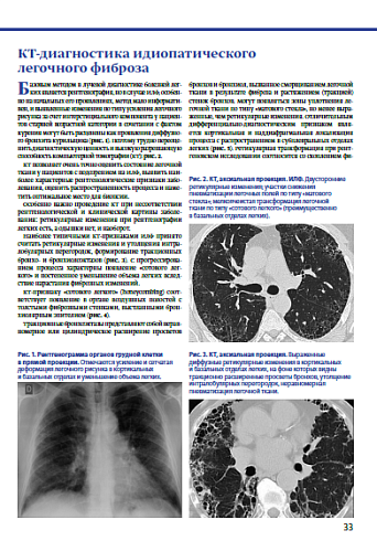 КТ-диагностика идиопатического легочного фиброза