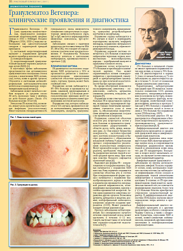 Гранулематоз Вегенера:  клинические проявления и диагностика