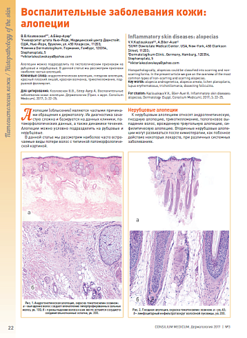 Воспалительные заболевания кожи: алопеции