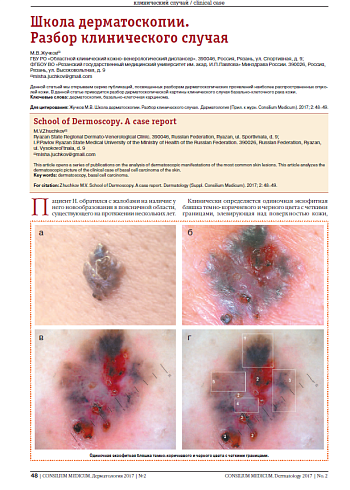 Школа дерматоскопии.  Разбор клинического случая