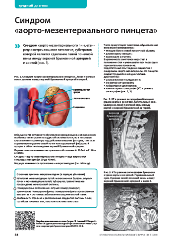 Синдром  «аорто-мезентериального пинцета»