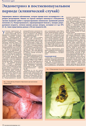 Эндометриоз в постменопаузальном  периоде (клинический случай)