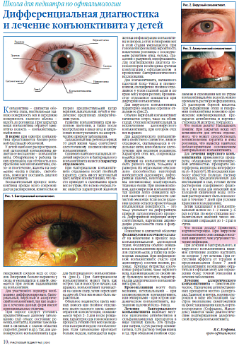 Дифференциальная диагностика и лечение конъюнктивита у детей