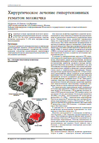 Хирургическое лечение гипертензивных гематом мозжечка