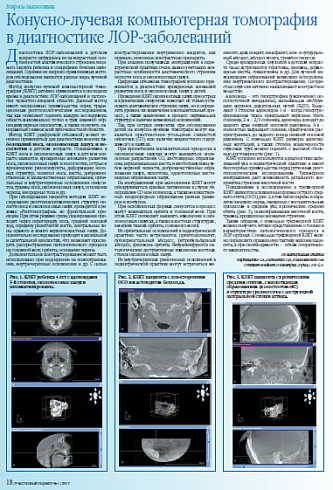 Конусно-лучевая компьютерная томография в диагностике ЛОР-заболеваний