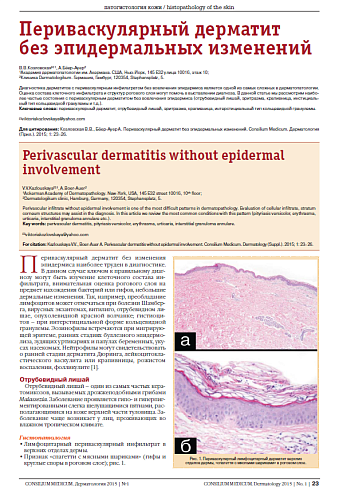 Периваскулярный дерматит  без эпидермальных изменений