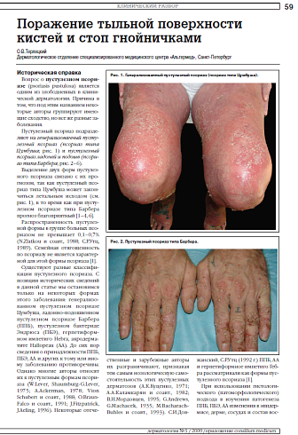 Поражение тыльной поверхности кистей и стоп гнойничками