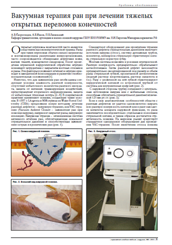 Вакуумная терапия ран при лечении тяжелых открытых переломов конечностей