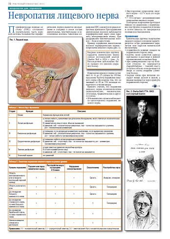 Невропатия лицевого нерва