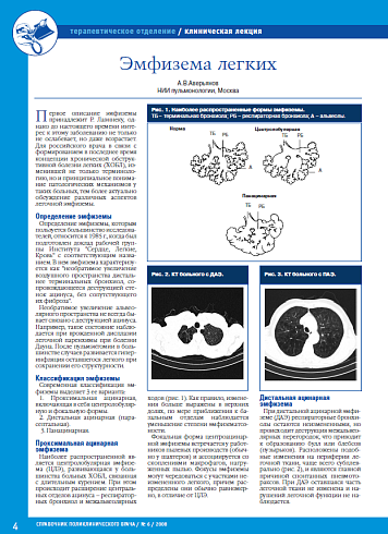 Эмфизема легких