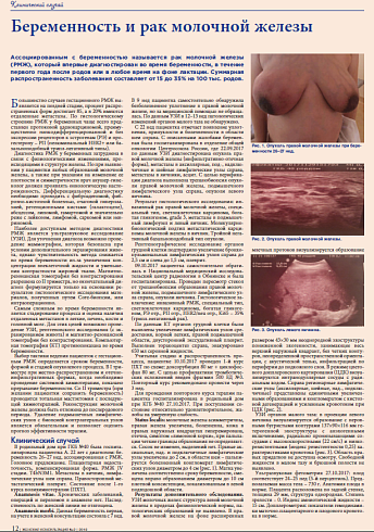 Беременность и рак молочной железы