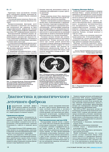 Диагностика идиопатического  легочного фиброза