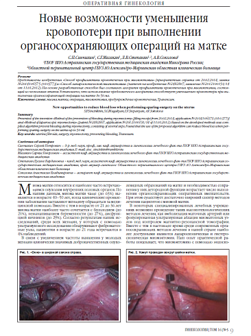 Новые возможности уменьшения кровопотери при выполнении органосохраняющих операций на матке