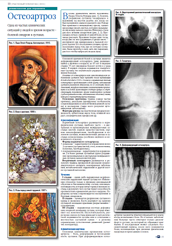 Остеоартроз