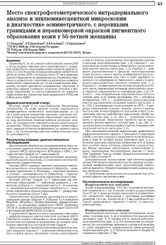 Место спектрофотометрического интрадермального анализа и эпилюминесцентной микроскопии в диагностике асимметричного, с неровными границами и неравномерной окраской пигментного образования кожи у 56-летней женщины
